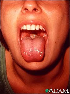 Mononucleosis - mouth Mononucleosis - mouth