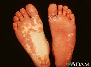 Sturge-Weber syndrome - soles of feet