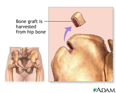 Bone graft harvest Bone graft harvest