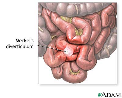 Meckels diverticulum Meckels diverticulum