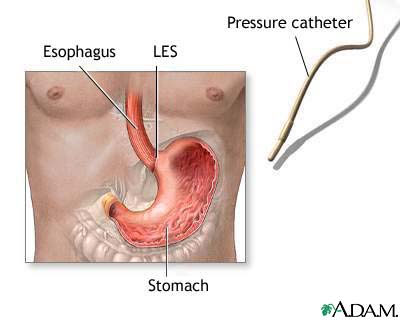 Esophageal manometry Esophageal manometry