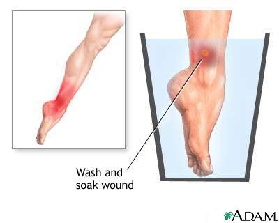 Jellyfish sting Jellyfish sting