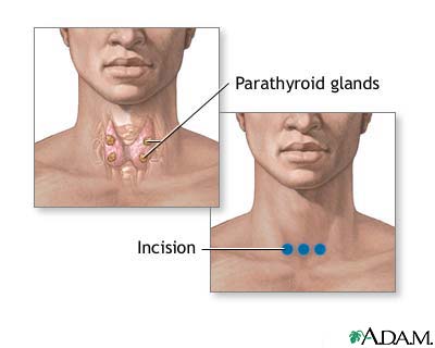 Parathyroid biopsy Parathyroid biopsy