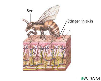 Bee sting Bee sting