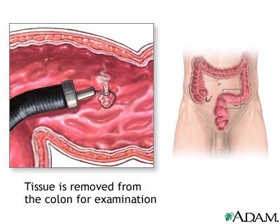 Colon culture Colon culture