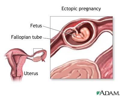 Ectopic pregnancy Ectopic pregnancy