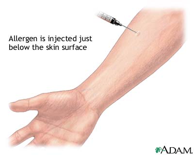 Aspergillus antigen skin test Aspergillus antigen skin test