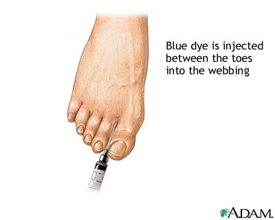 Lymphangiogram Lymphangiogram