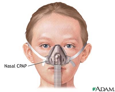 Nasal CPAP
