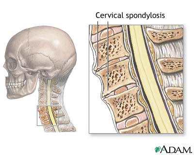 Cervical spondylosis