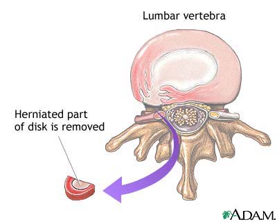 Herniated disk repair