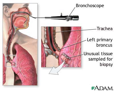 Bronchoscope