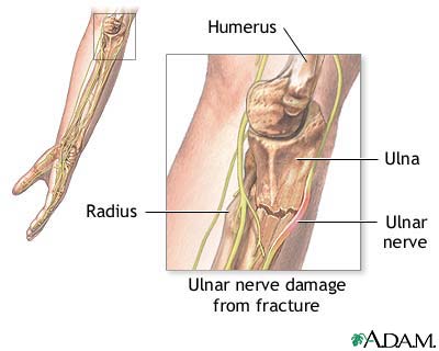 Ulnar nerve damage Ulnar nerve damage