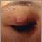 Granuloma annulare on the eyelid